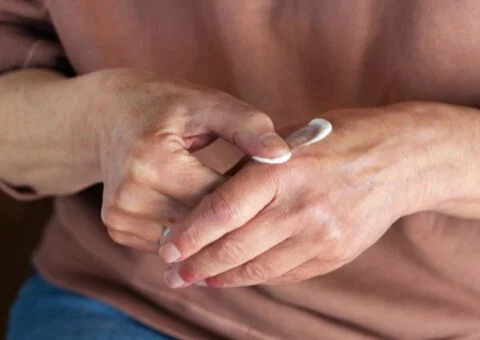 En patient med handeksem smörjer in sina händer.