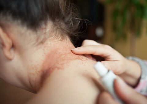 Internationella dagen för atopiskt eksem