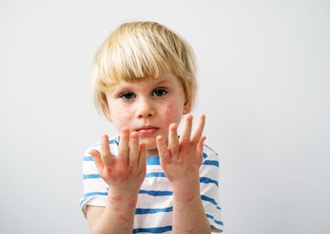 Barn med atopiskt eksem_600x424