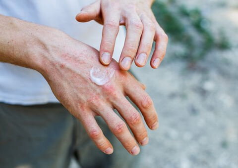 Välkommen på webbinarium om handeksem