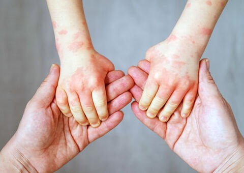 Anmäl dig till webbinarium om eksemvården